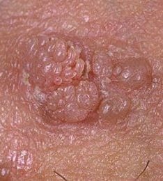 genital wart treatment in KL and Kepong