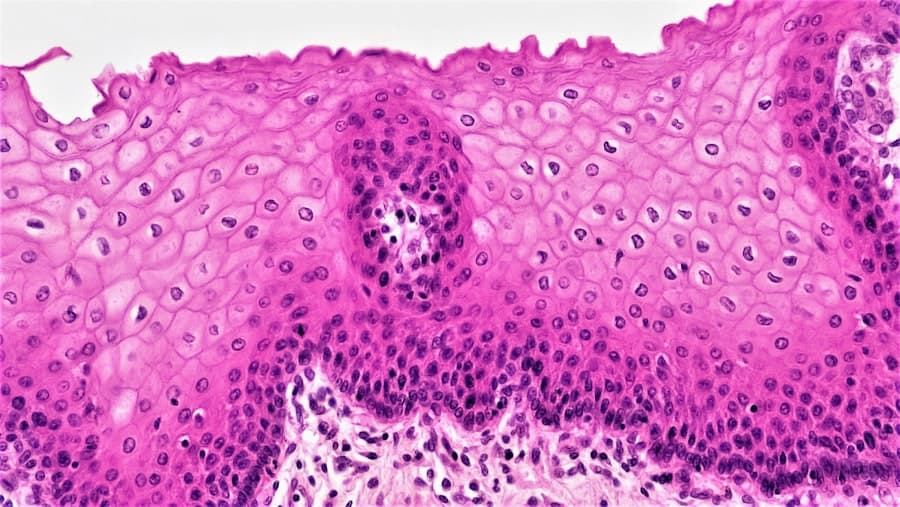 Microscope view of stained squamous epithelium tissue in pink and purple, with a darker cell cluster at its centre