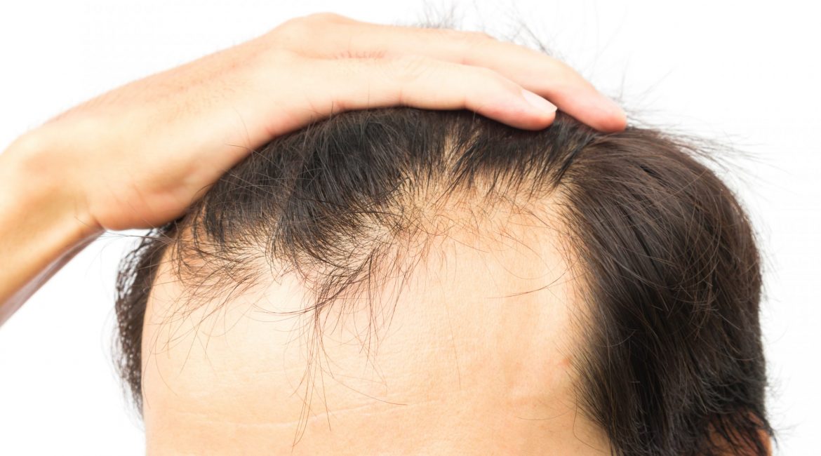 How to Prevent Hair Loss?