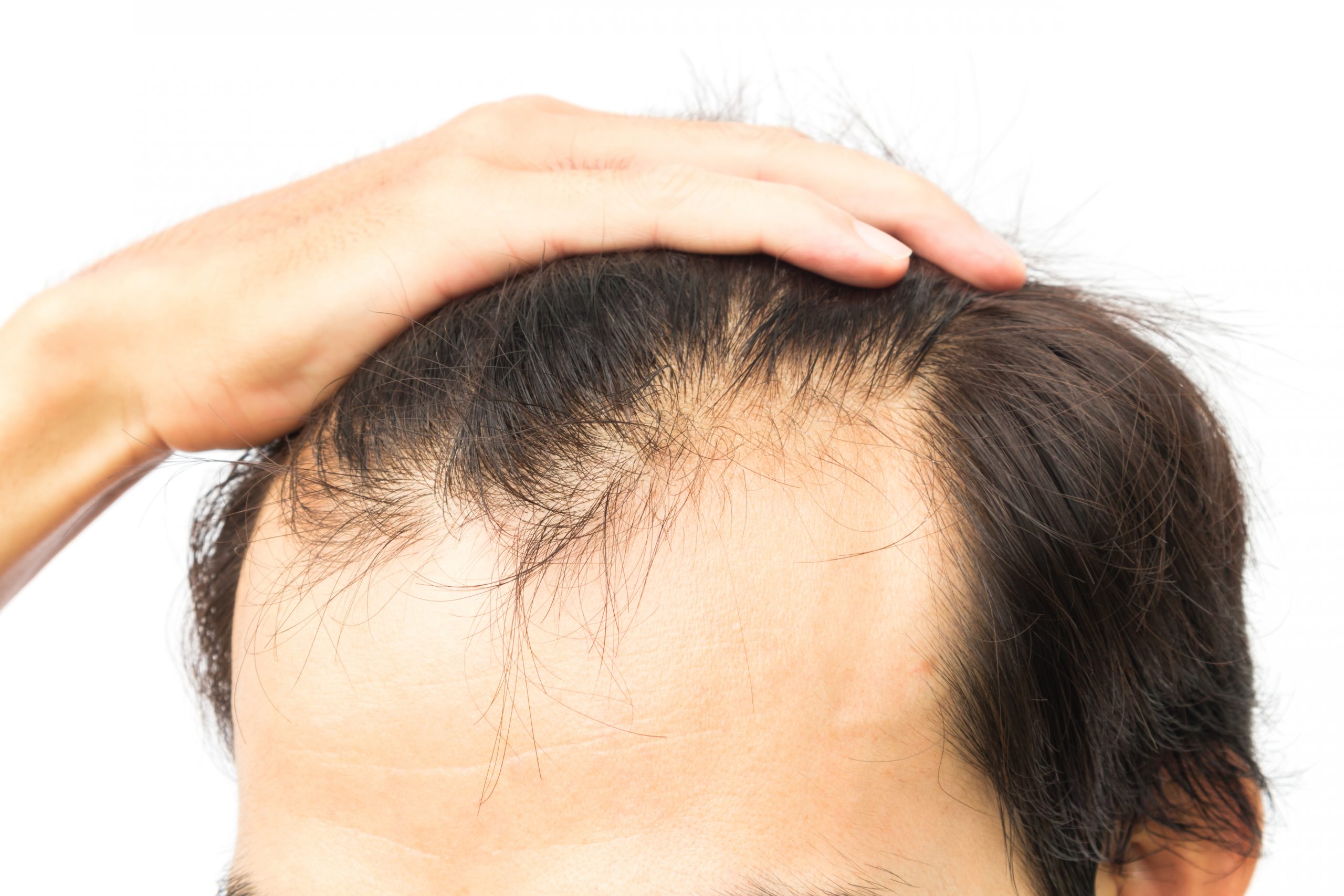 How to Prevent Hair Loss?