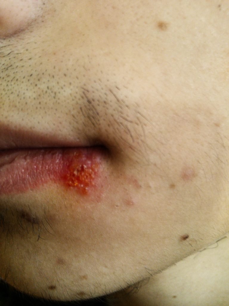 Managing Penile Ulcers: What to Do